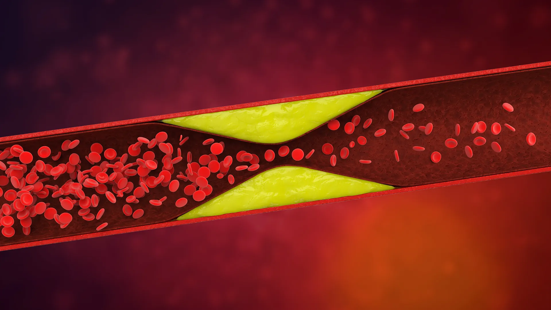 Genetic Mutation Combination Linked to Increased Blood Clot Risk
